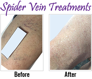 Spider Vein Treatment before and after